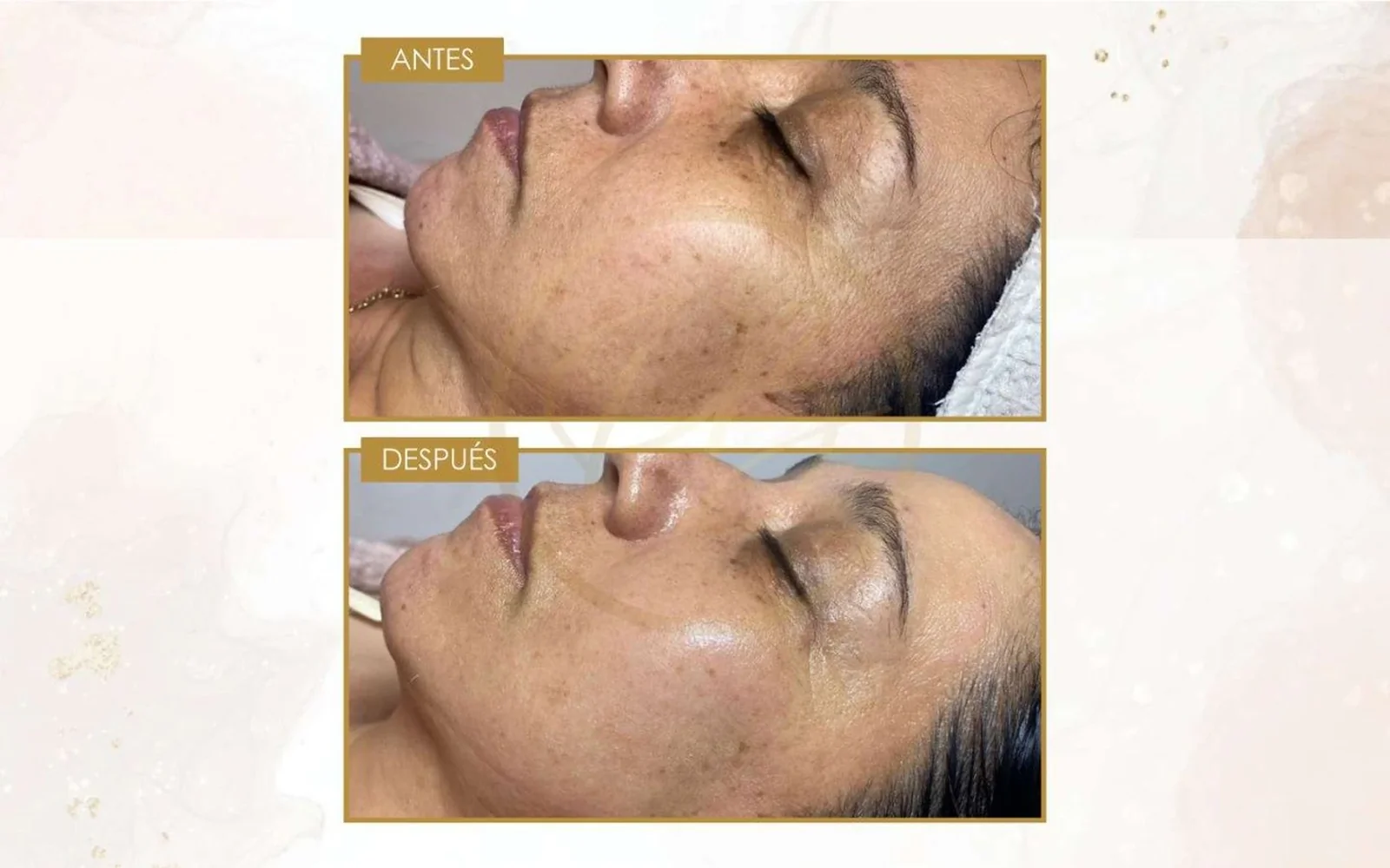 Antes 1